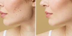 treatments for acne scars