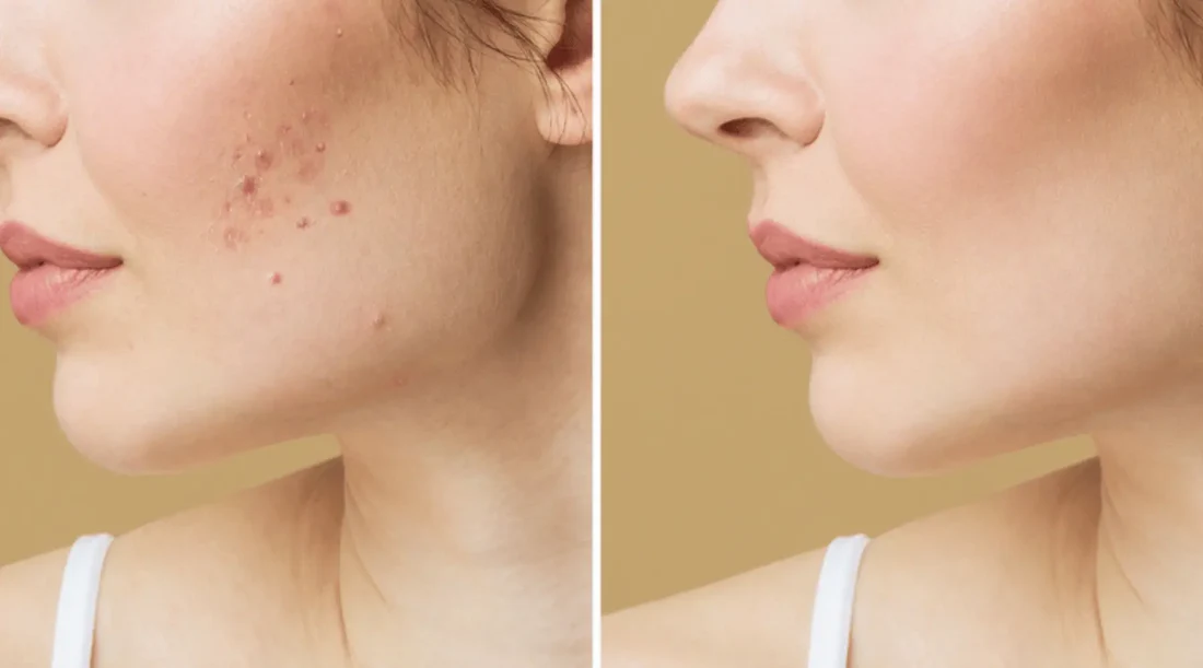 treatments for acne scars