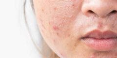 Skin Damage Repair with natural home remedies