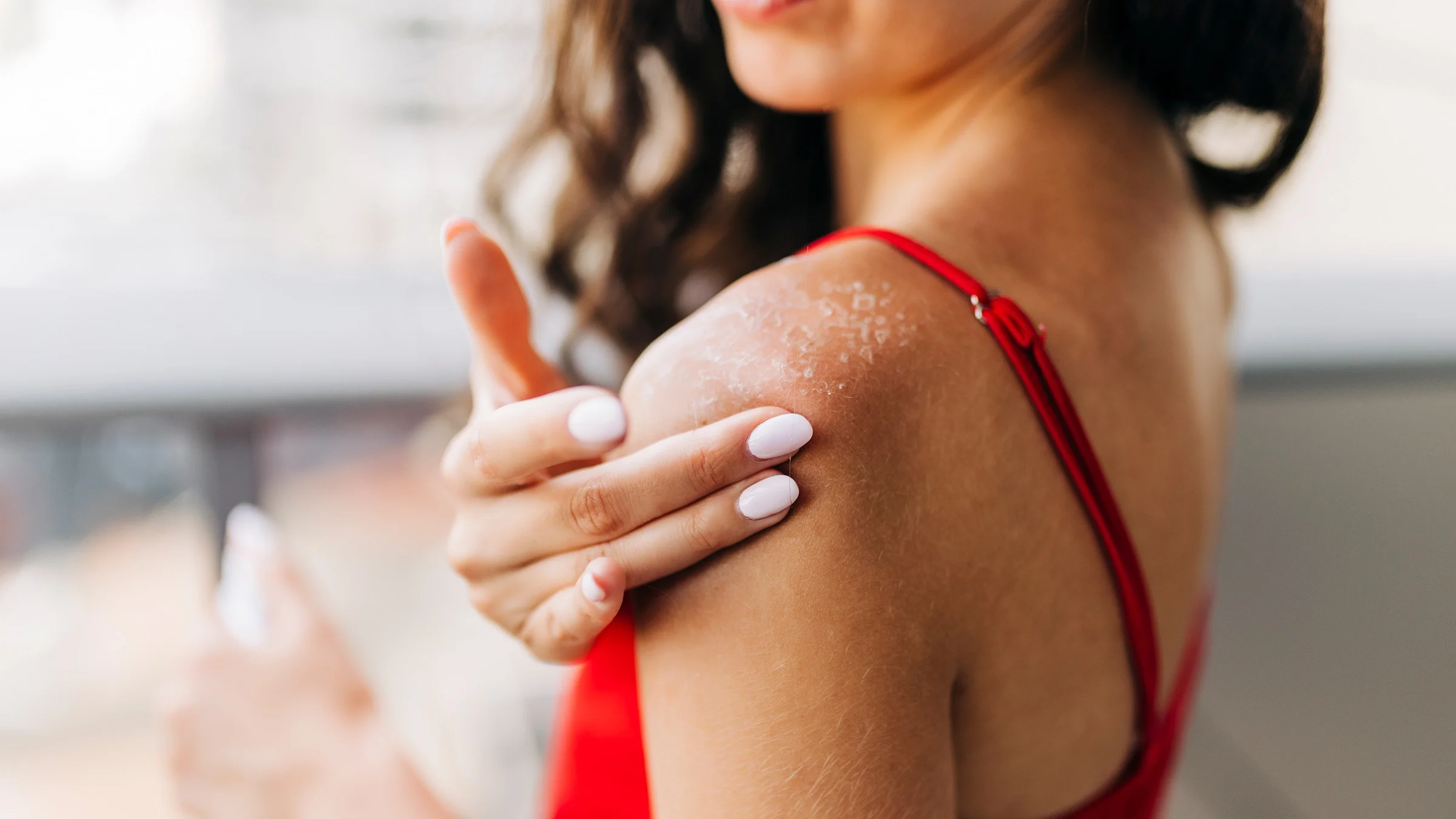Heal Sunburn Fast with proven skin repair tips